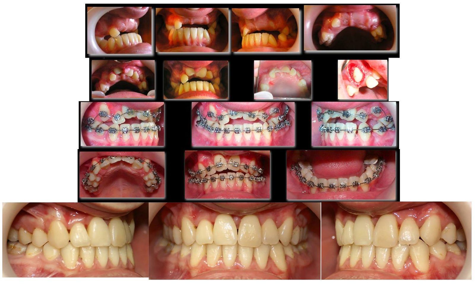 caz ortodontie incluzie dentara dinti inclusi
