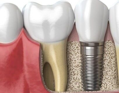 implant dentar titan plasat la mandibula