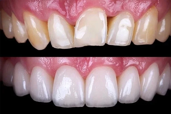 Fatete-dentare fatete dentare