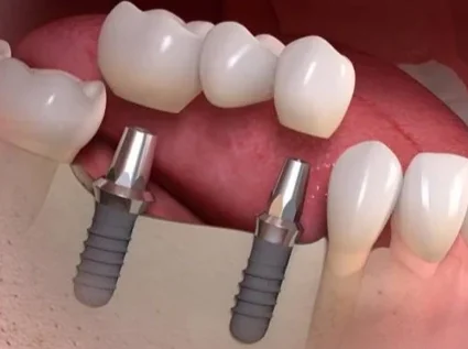 punte dentara pe implante implant dentar