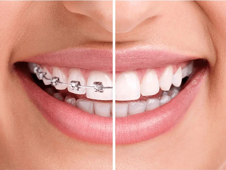 aparat dentar ceramica