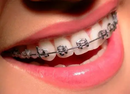 aparat dentar fix metalic