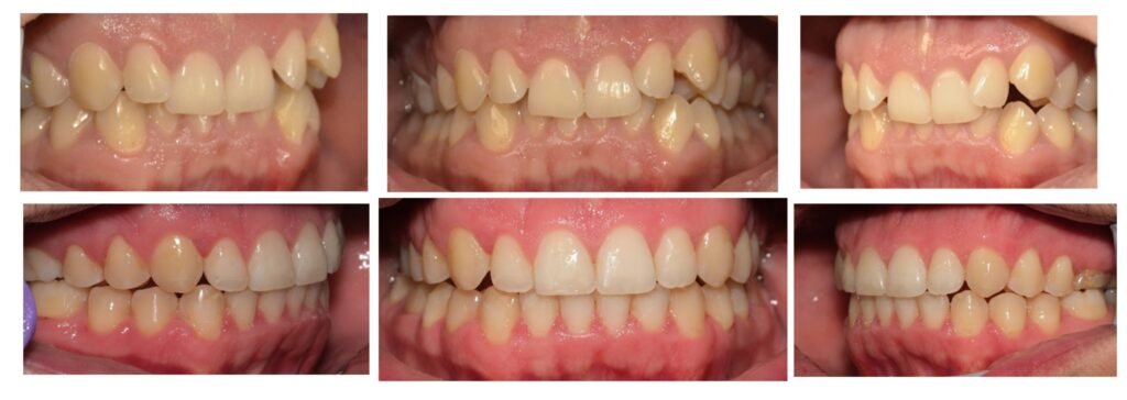 rezultat inainte dupa aparat dentar