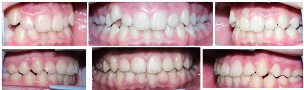 aparat dentar fix rezultat