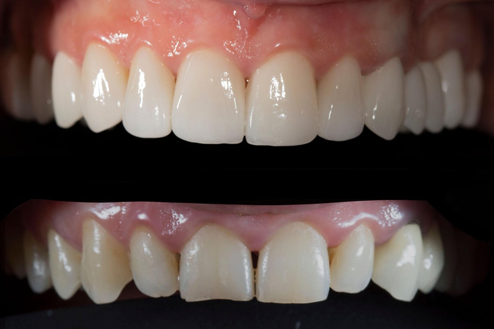Fatete dentare